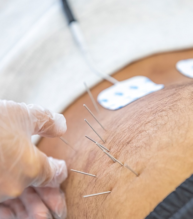 طب شرقی طب سوزنی